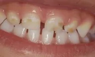 Teeth plaque